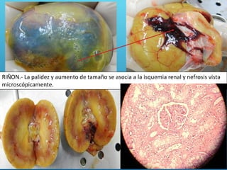 RIÑON.- La palidez y aumento de tamaño se asocia a la isquemia renal y nefrosis vista
microscópicamente.
 