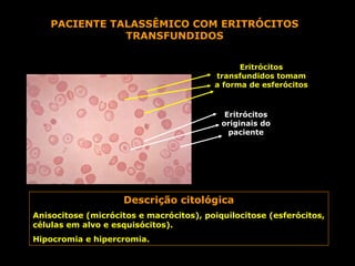 PACIENTE TALASSÊMICO COM ERITRÓCITOS
               TRANSFUNDIDOS


                                               Eritrócitos
                                         transfundidos tomam
                                         a forma de esferócitos



                                            Eritrócitos
                                           originais do
                                             paciente




                    Descrição citológica
Anisocitose (micrócitos e macrócitos), poiquilocitose (esferócitos,
células em alvo e esquisócitos).
Hipocromia e hipercromia.
 