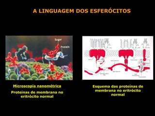 A LINGUAGEM DOS ESFERÓCITOS




Microscopia nanométrica    Esquema das proteínas de
                            membrana no eritrócito
Proteínas de membrana no
                                   normal
     eritrócito normal
 