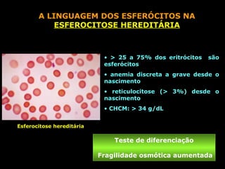A LINGUAGEM DOS ESFERÓCITOS NA
           ESFEROCITOSE HEREDITÁRIA



                            • > 25 a 75% dos eritrócitos   são
                            esferócitos
                            • anemia discreta a grave desde o
                            nascimento
                            • reticulocitose (> 3%) desde o
                            nascimento
                            • CHCM: > 34 g/dL


Esferocitose hereditária

                               Teste de diferenciação

                           Fragilidade osmótica aumentada
 