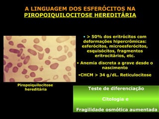 A LINGUAGEM DOS ESFERÓCITOS NA
   PIROPOIQUILOCITOSE HEREDITÁRIA


                        • > 50% dos eritrócitos com
                        deformações hipercrômicas:
                       esferócitos, microesferócitos,
                          esquisócitos, fragmentos
                             eritrocitários, etc.
                     • Anemia discreta a grave desde o
                                nascimento
                     •CHCM > 34 g/dL. Reticulocitose

Piropoiquilocitose
    hereditária          Teste de diferenciação

                                Citologia e

                     Fragilidade osmótica aumentada
 