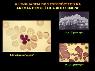 A LINGUAGEM DOS ESFERÓCITOS NA
     ANEMIA HEMOLÍTICA AUTO-IMUNE




                          M.E.: Aglutinação




Eritrócitos em “roseta”




                          M.O.: Aglutinação
 