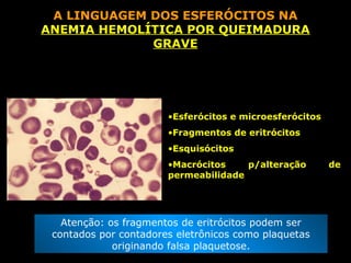 A LINGUAGEM DOS ESFERÓCITOS NA
ANEMIA HEMOLÍTICA POR QUEIMADURA
             GRAVE




                       •Esferócitos e microesferócitos
                       •Fragmentos de eritrócitos
                       •Esquisócitos
                       •Macrócitos    p/alteração        de
                       permeabilidade




   Atenção: os fragmentos de eritrócitos podem ser
 contados por contadores eletrônicos como plaquetas
             originando falsa plaquetose.
 