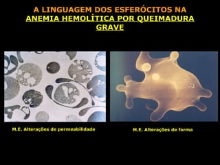 A LINGUAGEM DOS ESFERÓCITOS NA
     ANEMIA HEMOLÍTICA POR QUEIMADURA
                  GRAVE




M.E. Alterações de permeabilidade   M.E. Alterações de forma
 