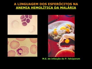 A LINGUAGEM DOS ESFERÓCITOS NA
 ANEMIA HEMOLÍTICA DA MALÁRIA




             M.E. de infecção do P. falciparum
 