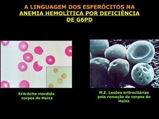 A LINGUAGEM DOS ESFERÓCITOS NA
ANEMIA HEMOLÍTICA POR DEFICIÊNCIA
            DE G6PD




Eritrócito mordido    M.E. Lesões eritrocitárias
 corpos de Heinz     pela remoção de corpos de
                               Heinz
 