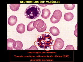 NEUTRÓFILOS COM VACÚOLOS




          Intoxicação por benzeno
Terapia com fator estimulante de células (GSF)
             Anomalia de Jordan
 