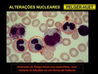 ALTERAÇÕES NUCLEARES                  PELGER-HUET




   Anomalia de Pelger-Huet nos neutrófilos, com
    núcleos bi-lobados ou em forma de halteres
 