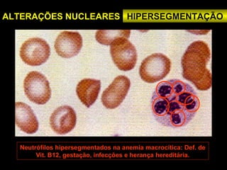 ALTERAÇÕES NUCLEARES HIPERSEGMENTAÇÃO




  Neutrófilos hipersegmentados na anemia macrocítica: Def. de
       Vit. B12, gestação, infecções e herança hereditária.
 