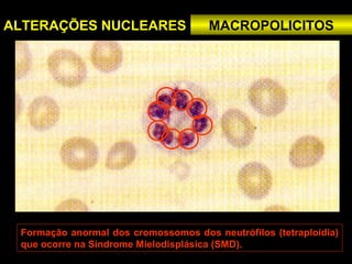ALTERAÇÕES NUCLEARES                  MACROPOLICITOS




 Formação anormal dos cromossomos dos neutrófilos (tetraploidia)
 que ocorre na Síndrome Mielodisplásica (SMD).
 