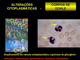 ALTERAÇÕES                           CORPOS DE
  CITOPLASMÁTICAS               -           DOHLE




Empilhamento do retículo endoplasmático e grânulos de glicogênio
Infecções, Inflamações, Queimaduras, Gestação, Citotóxicos
 