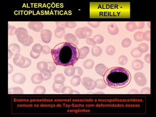 ALTERAÇÕES                        ALDER -
                            -
CITOPLASMÁTICAS                      REILLY




Enzima peroxidase anormal associada a mucopolissacaridose,
 comum na doença de Tay-Sachs com deformidades ósseas
                       congênitas
 