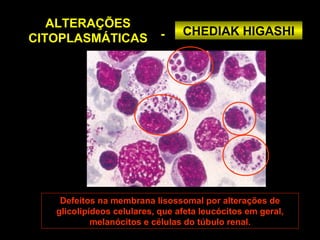 ALTERAÇÕES
                            -    CHEDIAK HIGASHI
CITOPLASMÁTICAS




    Defeitos na membrana lisossomal por alterações de
   glicolipídeos celulares, que afeta leucócitos em geral,
            melanócitos e células do túbulo renal.
 