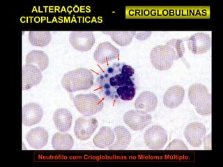 ALTERAÇÕES              -    CRIOGLOBULINAS
CITOPLASMÁTICAS




   Neutrófilo com Crioglobulinas no Mieloma Múltiplo.
 