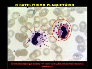O SATELITISMO PLAQUETÁRIO




É um processo que ocorre “in vitro” e resulta em trombocitopenia
                         “artefatual”.
 