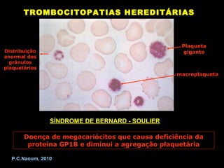 TROMBOCITOPATIAS HEREDITÁRIAS



                                                  Plaqueta
Distribuição                                      gigante
anormal dos
  grânulos
plaquetários
                                                macroplaqueta




                SÍNDROME DE BERNARD - SOULIER

       Doença de megacariócitos que causa deficiência da
        proteína GP1B e diminui a agregação plaquetária

  P.C.Naoum, 2010
 