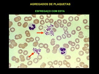 AGREGADOS DE PLAQUETAS

  ESFREGAÇO COM EDTA
 