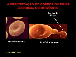 A PRECIPITAÇÃO DE CORPOS DE HEINZ
       DEFORMA O ERITRÓCITO
                            Corpos de
                              Heinz




 Eritrócito normal   Eritrócito anormal




P.C.Naoum, 2010
 