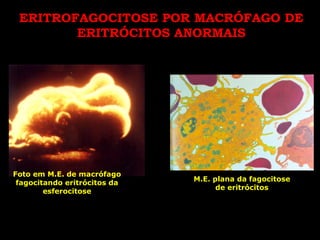 ERITROFAGOCITOSE POR MACRÓFAGO DE
        ERITRÓCITOS ANORMAIS




Foto em M.E. de macrófago
                              M.E. plana da fagocitose
 fagocitando eritrócitos da
                                    de eritrócitos
        esferocitose
 