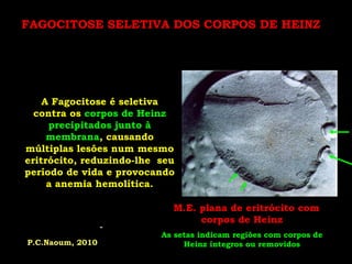 FAGOCITOSE SELETIVA DOS CORPOS DE HEINZ




    A Fagocitose é seletiva
  contra os corpos de Heinz
     precipitados junto à
     membrana, causando
múltiplas lesões num mesmo
eritrócito, reduzindo-lhe seu
período de vida e provocando
     a anemia hemolítica.

                           MM.E. plana de eritrócito com
                                 corpos de Heinz
                          As setas indicam regiões com corpos de
P.C.Naoum, 2010                Heinz íntegros ou removidos
 