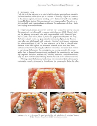 Interproximal Enamel Reduction in Lingual Orthodontics 
3. ALIGNMENT PHASE
Only the teeth that are going to be reduced will be aligned, principally the bicuspids.
The rotation of the upper molars will be corrected, if necessary (Figures 9.3–5a to c).
In the anterior segment, the initial crowding can be decreased by arch-form modifica-
tion and by labial tipping, if this was excepted in the treatment plan. The archwire is
fabricated with small expansion loops mesial to the first molars that will allow a slight
labial tipping of the anterior teeth.
4. INTERPROXIMAL ENAMEL REDUCTION BETWEEN FIRST MOLAR AND SECOND BICUSPID
The reduction is carried out with a tungsten carbide bur, type 699 L (Figure 9.3–6),
and the polishing is done with a bur with tungsten carbide blades (Komet) (Figure
9.3–7). After a brass wire is placed to protect the gingiva and to keep the lips away,
the bur is vertically positioned (perpendicular to the occlusal plane), and the move-
ment takes place labiolingually with progressive “nibbling” at the enamel with succes-
sive movements (Figure 9.3–8). The same movement can be done in a lingual–labial
direction. In the vertical plane, the movement is limited by the brass wire. Some
authors have recommended doing the reduction with vertical movements from bottom
to top, placing the bur under the contact point and moving occlusally. On young
adults, there is, danger of compressing the papilla with the protecting wire and render-
ing it a painful procedure. Moreover, the “nibbling” movement cannot be done verti-
cally, and there is the risk of overheating the bur and tooth by the continuous action.
Polishing is done by horizontal and vertical movements in order to eliminate any
overhanging enamel which could be formed under the contact point during the reduc-
 .-  . Correction of the rotated teeth which have to be reduced: (a) At the beginning of treatment.
(b) After derotation of rotated teeth. (c) After reproximation procedure.

 
 