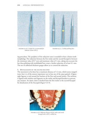  
ing procedure. The periphery of the reduction zone is rounded to have a better tooth
morphology. The reduction between the first molar and the second bicuspid is between
the minimum value of 0.7 mm and maximum value of 1 mm, taking into account the
fact that polishing with multibladed burs create a further reduction of at least 0.1 mm.
The use of calibrated thickness gauges allows us to control the reduction.
5. DISTALIZATION OF THE SECOND BICUSPID
The movement to be done has a maximum distance of 1.2 mm, which seems insignif-
icant, but it is of the utmost importance not to lose any of the space gained. A figure-
eight ligature is tied around the brackets of the first and second molars. The archwire
is ligated with stainless steel ligatures on the molar and bicuspid brackets to prevent
any rotation. An elastic chain is hooked from the first molar to the second bicuspid
for distalization of the biscuspid (Figure 9.3–9).
 .-. Carbide bur recommended for
reduction (Komet 699 L).
 .-. Carbide polishing burs.
 .-. Reduction between the first molar and second
bicuspid with a 699 L carbide bur.
 