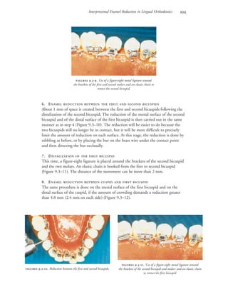 Interproximal Enamel Reduction in Lingual Orthodontics 
6. ENAMEL REDUCTION BETWEEN THE FIRST AND SECOND BICUSPIDS
About 1 mm of space is created between the first and second bicuspids following the
distalization of the second bicuspid. The reduction of the mesial surface of the second
bicuspid and of the distal surface of the first bicuspid is then carried out in the same
manner as in step 4 (Figure 9.3–10). The reduction will be easier to do because the
two bicuspids will no longer be in contact, but it will be more difficult to precisely
limit the amount of reduction on each surface. At this stage, the reduction is done by
nibbling as before, or by placing the bur on the brass wire under the contact point
and then directing the bur occlusally.
7. DISTALIZATION OF THE FIRST BICUSPID
This time, a figure-eight ligature is placed around the brackets of the second bicuspid
and the two molars. An elastic chain is hooked from the first to second bicuspid
(Figure 9.3–11). The distance of the movement can be more than 2 mm.
8. ENAMEL REDUCTION BETWEEN CUSPID AND FIRST BICUSPID
The same procedure is done on the mesial surface of the first bicuspid and on the
distal surface of the cuspid, if the amount of crowding demands a reduction greater
than 4.8 mm (2.4 mm on each side) (Figure 9.3–12).
 .-. Reduction between the first and second bicuspids.
 .-. Use of a figure-eight metal ligature around
the brackets of the first and second molars and an elastic chain to
retract the second bicuspid.
 .-. Use of a figure-eight metal ligature around
the brackets of the second bicuspid and molars and an elastic chain
to retract the first bicuspid.
 