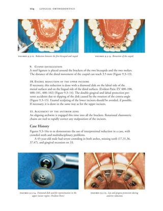  
9. CUSPID DISTALIZATION
A steel ligature is placed around the brackets of the two bicuspids and the two molars.
The distance of the distal movement of the cuspid can reach 3.5 mm (Figure 9.3–13).
10. ENAMEL REDUCTION OF THE UPPER INCISORS
If necessary, this reduction is done with a diamond disk on the labial side of the
mesial surfaces and on the lingual side of the distal surfaces. (Evident-Paris: EV 400–100,
400–101, 400–102) (Figure 9.3–14). The double gingival and labial protection pre-
vents accidents due to slipping of the disk caused by the rotation of the contra-angle
(Figure 9.3–15). Enamel sculpting of the lower incisors should be avoided, if possible.
If necessary, it is done in the same way as for the upper incisors.
11. ALIGNMENT OF THE ANTERIOR ZONE
An aligning archwire is engaged this time into all the brackets. Rotational elastomeric
chains are tied to rapidly correct any malposition of the incisors.
Case History
Figures 9.3–16a to m demonstrate the use of interproximal reduction in a case, with
crowded teeth and multidisciplinary problems.
A 45-year-old male had severe crowding in both arches, missing teeth (17,31,36,
37,47), and gingival recession on 33.
 .-. Reduction between the first bicuspid and cuspid.  .-. Retraction of the cuspid.
 .-. Diamond disk used for reproximation in the
upper incisor region. (Evident-Paris)
 .-. Lip and gingiva protection during
anterior reduction.
 