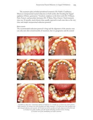 Interproximal Enamel Reduction in Lingual Orthodontics 
 .-  . Consecutive sequences of reduction in a crowded case: (a) Front view of the occlusion
before treatment. (b) Occlusal view of the maxillary arch before treatment. (c) Occlusal view of the maxillary arch
after bicuspid reduction and retraction. (d) Occlusal view of the maxillary arch after alignment of all of the teeth.
(e) Occlusal view of the maxillary arch after bracket-debonding and fixed retainer bonding.
(f) Occlusal view of the mandibulary-arch before treatment.
 
 
 
The treatment plan included periodontal treatment (Dr. Kadiri, Casablanca,
Morocco) interproximal enamel reduction on both arches after bonding the lingual
appliance (Ormco, generation 7 brackets), implants in the lower arch (Dr. P. Khayat,
Paris, France), and porcelain laminates (Dr. P. Miara, Paris, France). Total treatment
time was 18 months, much shorter than usually expected in such cases due to the very
clear and simple interproximal reduction protocol.
DISCUSSION
The recommended reduction protocol is long and the alignment of the anterior zone
can only start after several months of treatment, but it is progressive and the enamel
 
