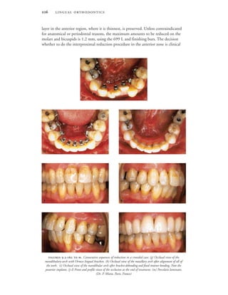  
layer in the anterior region, where it is thinnest, is preserved. Unless contraindicated
for anatomical or periodontal reasons, the maximum amounts to be reduced on the
molars and bicuspids is 1.2 mm, using the 699 L and finishing burs. The decision
whether to do the interproximal reduction procedure in the anterior zone is clinical
 .-  . Consecutive sequences of reduction in a crowded case: (g) Occlusal view of the
mandibulary-arch with Ormco lingual brackets. (h) Occlusal view of the maxillary arch after alignment of all of
the teeth. (i) Occlusal view of the mandibular arch after bracket-debonding and fixed retainer bonding. Note the
posterior implants. (j–l) Front and profile views of the occlusion at the end of treatment. (m) Porcelain laminates.
(Dr. P. Miara, Paris, France)

 
 
 
 