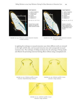 Sliding Mechanics versus Loop Mechanics During En Masse Retraction in Extraction Cases 
in applying the technique to unusual extraction cases where different teeth are extracted
on the right and left sides, and increased retraction time and consequently increased
treatment time. The technique of sliding mechanics has the advantage of being simple
and effective for preventing transverse bowing effects without using a transpalatal arch.
 .-. Momentum analysis of anterior retraction
in labial mechanics.
 .-. Momentum analysis of anterior retraction
in lingual mechanics.
 .-. Archwires used for en masse
retraction: Closed helical loops mechanics.
 .-. Archwires used for en masse
retraction: L-loops mechanics.
 .-. Archwires used for en masse
retraction: T-loops mechanics.
Labial Appliance
O: center of resistance
FR: retraction force
FI: intrusion force
M1: moment
D0: Distance to FR
D1: Distance to FI
M1 = D0 • FR – D1 • FI = 0
Intrusion force in Labial
Appliance will affect the
bodily movement of teeth.
Lingual Appliance
O: center of resistance
FR: retraction force
FI: intrusion force
M2: moment
D0: Distance to FR
D2: Distance to FI
M2 = D0 • FR – D2 • FI > 0
However, it may also
react as tipping force in
Lingual Appliance due to
the differences in force
direction.
O O
M1
M2
FR
FR
FI
FI
D1
D2
D0
D0
 