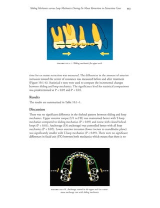 Sliding Mechanics versus Loop Mechanics During En Masse Retraction in Extraction Cases 
time for en masse retraction was measured. The differences in the amount of anterior
intrusion toward the center of resistance was measured before and after treatment
(Figure 10.1–6). Statistical t-tests were used to compare the incremental changes
between sliding and loop mechanics. The significance level for statistical comparisons
was predetermined at P < 0.05 and P < 0.01.
Results
The results are summarized in Table 10.1–1.
Discussion
There was no significant difference in the skeletal pattern between sliding and loop
mechanics. Upper anterior torque (U1 to FH) was maintained better with T-loop
mechanics compared to sliding mechanics (P < 0.05) and worse with closed helical
loops (P < 0.01). Anchorage (U6 anchorage) was controlled better with all loop
mechanics (P < 0.05). Lower anterior intrusion (lower incisor to mandibular plane)
was significantly smaller with T-loop mechanics (P < 0.05). There were no significant
differences in facial axis (FX) between both mechanics which means that there is no
 .-. Sliding mechanics for upper arch.
 .-. Anchorage control in the upper arch in a mini-
mum anchorage case with sliding mechanics.
cl III el cl III el
 