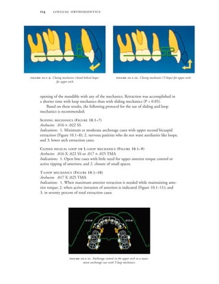 
opening of the mandible with any of the mechanics. Retraction was accomplished in
a shorter time with loop mechanics than with sliding mechanics (P = 0.05).
Based on these results, the following protocol for the use of sliding and loop
mechanics is recommended:
SLIDING MECHANICS (FIGURE 10.1–7)
Archwire: .016 × .022 SS
Indications: 1. Minimum or moderate anchorage cases with upper second bicuspid
extraction (Figure 10.1–8); 2. nervous patients who do not want auxiliaries like loops;
and 3. lower arch extraction cases.
CLOSED HELICAL LOOP OR L-LOOP MECHANICS (FIGURE 10.1–9)
Archwire: .016 X .022 SS or .017 × .025 TMA
Indications: 1. Open bite cases with little need for upper anterior torque control or
active tipping of anteriors; and 2. closure of small spaces.
T-LOOP MECHANICS (FIGURE 10.1–10)
Archwire: .017 X .025 TMA
Indications: 1. When maximum anterior retraction is needed while maintaining ante-
rior torque; 2. when active intrusion of anteriors is indicated (Figure 10.1–11); and
3. in seventy percent of total extraction cases.
 .-. Closing mechanics (closed helical loops)
for upper arch.
 .-. Closing mechanics (T-loops) for upper arch.
 .-. Anchorage control in the upper arch in a maxi-
mum anchorage case with T-loop mechanics.
cl II el cl II el
 