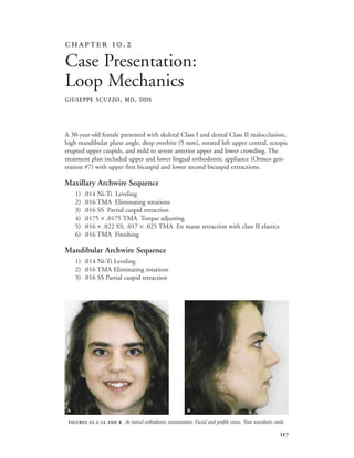 
A 30-year-old female presented with skeletal Class I and dental Class II malocclusion,
high mandibular plane angle, deep overbite (5 mm), rotated left upper central, ectopic
erupted upper cuspids, and mild to severe anterior upper and lower crowding. The
treatment plan included upper and lower lingual orthodontic appliance (Ormco gen-
eration #7) with upper first bicuspid and lower second bicuspid extractions.
Maxillary Archwire Sequence
1) .014 Ni-Ti Leveling
2) .016 TMA Eliminating rotations
3) .016 SS Partial cuspid retraction
4) .0175 × .0175 TMA Torque adjusting
5) .016 × .022 SS; .017 × .025 TMA En masse retraction with class II elastics
6) .016 TMA Finishing
Mandibular Archwire Sequence
1) .014 Ni-Ti Leveling
2) .016 TMA Eliminating rotations
3) .016 SS Partial cuspid retraction
 .
Case Presentation:
Loop Mechanics
GIUSEPPE SCUZZO, MD, DDS
 .-  . At initial orthodontic examination: Facial and profile views. Note unesthetic smile.
 
 