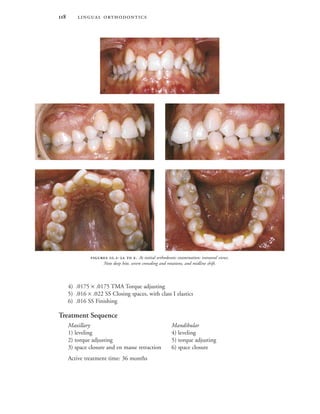  
4) .0175 × .0175 TMA Torque adjusting
5) .016 × .022 SS Closing spaces, with class I elastics
6) .016 SS Finishing
Treatment Sequence
Maxillary Mandibular
1) leveling 4) leveling
2) torque adjusting 5) torque adjusting
3) space closure and en masse retraction 6) space closure
Active treatment time: 36 months

 
 
 .-  . At initial orthodontic examination: intraoral views.
Note deep bite, severe crowding and rotations, and midline shift.
 