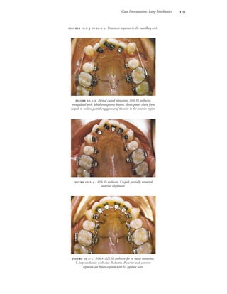 Case Presentation: Loop Mechanics 
 .-. Partial cuspid retraction: .016 SS archwire,
transpalatal arch, labial transparent button, elastic power chain from
cuspids to molars, partial engagement of the wire in the anterior region.
 .-. .016 × .022 SS archwire for en masse retraction.
L-loop mechanics with class II elastics. Posterior and anterior
segments are figure-eighted with SS ligature wire.
 .-. .016 SS archwire. Cuspids partially retracted,
anterior alignment.
 .-  .-. Treatment sequence in the maxillary arch.
 