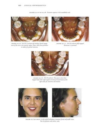  
 .-. .016 SS archwire fully engaged.
Retraction is continued.
 .-. .016 SS archwire. Note power chain from
lingual hook of the right cuspid to the buccal metal button of the
right molar for retraction and rotation.
 .-  . At the end of orthodontic treatment: facial and profile views.
Note the pleasant and esthetic smile.
 
 .-. .014 Ni-Ti archwire for leveling. Partial engage-
ment of the wire in the anterior region. Power chain from premolars
to molars for partial retraction.
 .-  .-. Treatment sequence in the mandibular arch.
 