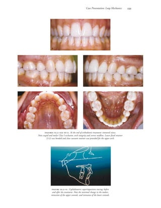 Case Presentation: Loop Mechanics 

 
 
 .-  . At the end of orthodontic treatment: intraoral views.
Note cuspid and molar Class I occlusion, arch integrity and correct midline. Lower fixed retainer
(3-3) was bonded and clear vacuum retainer was provided for the upper arch.
 .-. Cephalometric superimposition tracing: before
and after the treatment. Note the minimal change in the molars,
retraction of the upper centrals, and intrusion of the lower centrals.
 