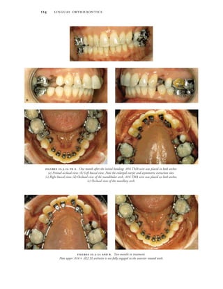  
 .-  . One month after the initial bonding; .016 TMA wire was placed in both arches:
(a) Frontal occlusal view. (b) Left buccal view. Note the enlarged overjet and asymmetric extraction sites.
(c) Right buccal view. (d) Occlusal view of the mandibular arch, .016 TMA wire was placed on both arches.
(e) Occlusal view of the maxillary arch.

 

 

 .-  . Two months in treatment.
Note upper .016 × .022 SS archwire is not fully engaged in the anterior rotated teeth.
 