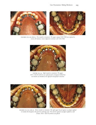 Case Presentation: Sliding Mechanics 
 
 .-  . Eleven months in treatment. The right upper buccal segment was figure-eighted
to include the bicuspid in the posterior anchorage unit. The anterior segment was figure-eighted as well.
A lower .016 × .022 SS archwire was placed.
 
 .-  . Five months in treatment. The upper original .016 TMA was replaced to
correct all rotations. Lower alignment continues with .016 TMA.
 .-. Eight months in treatment. The upper
.016 × .022 SS archwire was replaced and a transparent labial but-
ton bracket was bonded to the right first bicuspid for retraction.
 