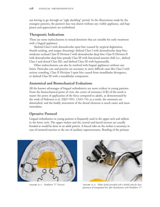  
out having to go through an “ugly duckling” period. In the illustrations made by the
youngest patients, the patient’s face was drawn without any visible appliance, and hap-
piness and appreciation are symbolized.
Therapeutic Indications
There are some malocclusions in mixed dentition that are suitable for early treatment
with a lingual appliance:
Skeletal Class I with dentoalveolar open bite (caused by atypical deglutition,
thumb sucking, and tongue thrusting); skeletal Class I with dentoalveolar deep bite;
moderate occlusal Class II Division I with dentoalveolar deep bite; Class II Division II
with dentoalveolar deep bite; pseudo Class III with functional anterior shift (i.e., skeletal
Class I and dental Class III); and skeletal Class III with hypomaxilla.
Other malocclusions can also be resolved with lingual appliances without any
limits. Particular care and practice are necessary in more difficult cases like Class I with
serious crowding, Class II Division I open bite caused from mandibular divergence,
or skeletal Class III with a mandibular component.
Anatomical and Biomechanical Evaluations
All the known advantages of lingual orthodontics are more evident in young patients.
From the biomechanical point of view, the center of resistance (CR) of the tooth is
nearer the point of application of the force compared to adults, as demonstrated by
the work of Pederson et al. (EJO 1991; 13:65–74); as a result, the moments are
diminished, and the bodily movement of the dental elements is much easier and more
immediate.
Operative Protocol
Lingual orthodontics in young patients is frequently used in the upper arch and seldom
in the lower arch. The upper molars and the central and lateral incisors are usually
bonded as would be done in an adult patient. A buccal tube on the molars is necessary in
case of extraoral traction or the use of auxiliary superstructures. Bonding of the primary
 -. Pendulum “F” (Favero).  -. Molar bands provided with a double tube for later
placement of transpalatal bar, after distalization with Pendulum “F”.
 