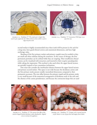 Lingual Orthodontics in Pediatric Patients 
second molars is highly recommended since these teeth will be present in the arch for
a long time, have good clinical crowns and anatomical dimensions, and have high
anchorage value.
Bonding of the first primary molars and primary cuspids must be avoided as they
are small and often exfoliate during the treatment. In the course of therapy, the first
permanent premolars can be utilized while they are erupting. Their insufficient clinical
crowns can be visualized with retraction cord inserted in their eruptive pseudopocket
while taking the impression. This method is also used when the upper lateral incisors
are partially erupted or have anomalous inclinations.
One must also consider the interbracket distance between the upper lateral incisors
and primary second molars. This space is not wide because the deciduous canine and
the first primary molar present smaller mesiodistal dimensions compared to their
permanent successors. The wire offset between the primary cuspid and the primary molar
is very small because of the anatomical arrangement of deciduous teeth in the arch and
the absence of the canine protuberance, and because the contraction loops that are used
 -. Pendulum “F.” The acrylic part is larger than
usual to give support for the TMA archwire section which is used to
align the front teeth.
 -. Pendulum “F.” Contraction TMA loops in an
open-bite case.
 -. Pendulum “F.” The anterior bite effect of the
anterior lingual brackets facilitates molar distalization. Sagittal
screw to activate the appliance.
 -. Pendulum “F.” A tongue crib is inserted into the
acrylic button in cases of open-bite and tongue-thrust habits.
 