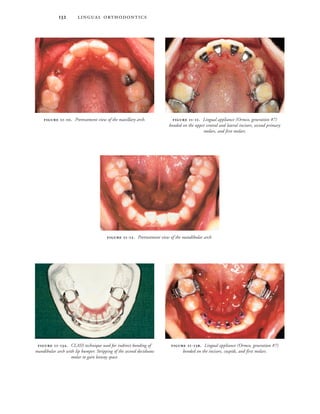  
 -. Pretreatment view of the maxillary arch.
 -. Pretreatment view of the mandibular arch.
 -. Lingual appliance (Ormco, generation #7)
bonded on the upper central and lateral incisors, second primary
molars, and first molars.
 -. CLASS technique used for indirect bonding of
mandibular arch with lip bumper. Stripping of the second deciduous
molar to gain leeway space.
 -. Lingual appliance (Ormco, generation #7)
bonded on the incisors, cuspids, and first molars.
 