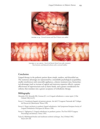 Lingual Orthodontics in Pediatric Patients 
Conclusion
Lingual therapy in the pediatric patient shows simple, modern, and diversified use.
The numerous advantages are represented by a remarkable psychological acceptability,
smaller interferences with removable appliances, a shorter treatment time, biomechan-
ical advantages (such as increase of sagittal and transverse expansive effects), a greater
effectiveness of superstructures such as elastic bands, and a greater consideration for
esthetics that translates into a greater acceptance of orthodontic therapy.
Bibliography
Alexander CM, Alexander RG, Gorman JC, et al. Lingual orthodontics: a status report. J Clin
Orthod 1982;16:255.
Favero L. L’ortodonzia linguale nel paziente giovane. Atti del 3° Congresso Nazionale del “Collegio
dei Docenti di Odontoiatria” Roma 1996.
Favero L. Proper mechanics in pediatric lingual orthodontics. 2nd Symposium European Society of
Lingual Orthodontics Principaut de Monaco 1996.
Favero L, Tagliapietra S. Lingual orthodontics in paediatric patient. The First ESLO Congress.
Proceedings and abstracts. Venice 1993.
Fujita K. Multilingual-bracket and mushroom archwire technique. Am J Orthod 1982;
82(2):120–140.
 -. Cervical traction and Class II elastics were added.
 -  . Facial and lateral clinical views after treatment:
Note harmonic and balanced occlusion with a corrected midline.
 
 