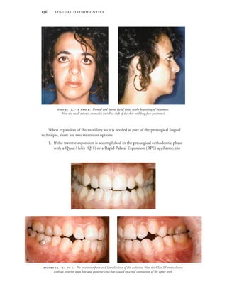  
When expansion of the maxillary arch is needed as part of the presurgical lingual
technique, there are two treatment options:
1. If the traverse expansion is accomplished in the presurgical orthodontic phase
with a Quad-Helix (QH) or a Rapid Palatal Expansion (RPE) appliance, the
 .-  . Frontal and lateral facial views at the beginning of treatment.
Note the small esthetic anomalies (midline shift of the chin and long face syndrome).
 
 .-  . Pre-treatment front and laterals views of the occlusion. Note the Class III malocclusion
with an anterior open bite and posterior cross-bite caused by a real contraction of the upper arch.
 

 
