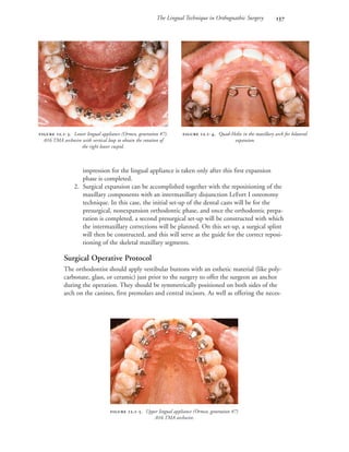 The Lingual Technique in Orthognathic Surgery 
impression for the lingual appliance is taken only after this first expansion
phase is completed.
2. Surgical expansion can be accomplished together with the repositioning of the
maxillary components with an intermaxillary disjunction LeFort I osteotomy
technique. In this case, the initial set-up of the dental casts will be for the
presurgical, nonexpansion orthodontic phase, and once the orthodontic prepa-
ration is completed, a second presurgical set-up will be constructed with which
the intermaxillary corrections will be planned. On this set-up, a surgical splint
will then be constructed, and this will serve as the guide for the correct reposi-
tioning of the skeletal maxillary segments.
Surgical Operative Protocol
The orthodontist should apply vestibular buttons with an esthetic material (like poly-
carbonate, glass, or ceramic) just prior to the surgery to offer the surgeon an anchor
during the operation. They should be symmetrically positioned on both sides of the
arch on the canines, first premolars and central incisors. As well as offering the neces-
 .-. Lower lingual appliance (Ormco, generation #7).
.016 TMA archwire with vertical loop to obtain the rotation of
the right lower cuspid.
 .-. Quad-Helix in the maxillary arch for bilateral
expansion.
 .-. Upper lingual appliance (Ormco, generation #7)
.016 TMA archwire.
 