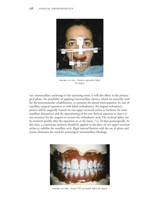  
sary intermaxillary anchorage in the operating room, it will also allow, in the postsur-
gical phase, the possibility of applying intermaxillary elastics, which are normally used
for the neuromuscular rehabilitation, to optimize the dental intercuspation. In case of
maxillary surgical expansion as with labial orthodontics, the lingual orthodontic
patient will be surgically treated via two upper sectional arches to facilitate the inter-
maxillary disjunction and the repositioning of the two skeletal segments so that it is
not necessary for the surgeon to section the orthodontic arch. The occlusal splint can
be removed quickly after the operation or, at the latest, 7 to 10 days postsurgically. At
this time, a continuous archwire should be applied in the place of two upper sectional
arches to stabilize the maxillary arch. Rigid internal fixation with the use of plates and
screws eliminates the need for postsurgical intermaxillary blockage.
 .-. Facebow registration before
the surgery.
 .-. Set-up VTO cast models before the surgery.
 