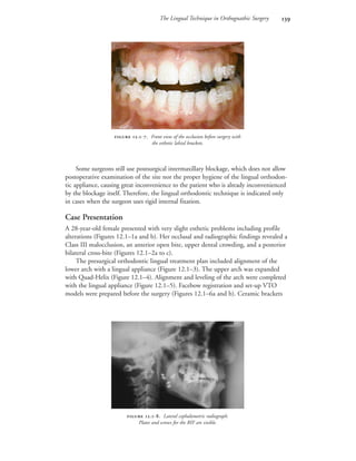 The Lingual Technique in Orthognathic Surgery 
Some surgeons still use postsurgical intermaxillary blockage, which does not allow
postoperative examination of the site nor the proper hygiene of the lingual orthodon-
tic appliance, causing great inconvenience to the patient who is already inconvenienced
by the blockage itself. Therefore, the lingual orthodontic technique is indicated only
in cases when the surgeon uses rigid internal fixation.
Case Presentation
A 28-year-old female presented with very slight esthetic problems including profile
alterations (Figures 12.1–1a and b). Her occlusal and radiographic findings revealed a
Class III malocclusion, an anterior open bite, upper dental crowding, and a posterior
bilateral cross-bite (Figures 12.1–2a to c).
The presurgical orthodontic lingual treatment plan included alignment of the
lower arch with a lingual appliance (Figure 12.1–3). The upper arch was expanded
with Quad-Helix (Figure 12.1–4). Alignment and leveling of the arch were completed
with the lingual appliance (Figure 12.1–5). Facebow registration and set-up VTO
models were prepared before the surgery (Figures 12.1–6a and b). Ceramic brackets
 .-. Front view of the occlusion before surgery with
the esthetic labial brackets.
 .-. Lateral cephalometric radiograph.
Plates and screws for the RIF are visible.
 