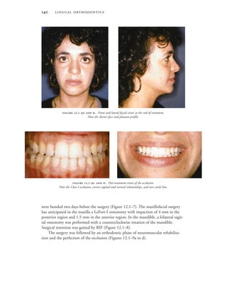  
were bonded two days before the surgery (Figure 12.1–7). The maxillofacial surgery
has anticipated in the maxilla a LeFort-I osteotomy with impaction of 4 mm in the
posterior region and 1.5 mm in the anterior region. In the mandible, a bilateral sagit-
tal osteotomy was performed with a counterclockwise rotation of the mandible.
Surgical retention was gained by RIF (Figure 12.1–8).
The surgery was followed by an orthodontic phase of neuromuscular rehabilita-
tion and the perfection of the occlusion (Figures 12.1–9a to d).
 .-  . Post-treatment views of the occlusion.
Note the Class I occlusion, correct sagittal and vertical relationships, and nice smile line.
 
 .-  . Front and lateral facial views at the end of treatment.
Note the shorter face and pleasant profile.
 
 