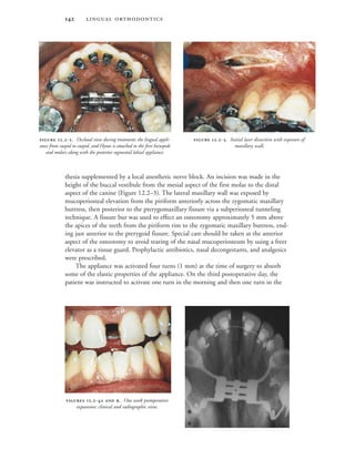  
thesia supplemented by a local anesthetic nerve block. An incision was made in the
height of the buccal vestibule from the mesial aspect of the first molar to the distal
aspect of the canine (Figure 12.2–3). The lateral maxillary wall was exposed by
mucoperiosteal elevation from the piriform anteriorly across the zygomatic maxillary
buttress, then posterior to the pterygomaxillary fissure via a subperiosteal tunneling
technique. A fissure bur was used to effect an osteotomy approximately 5 mm above
the apices of the teeth from the piriform rim to the zygomatic maxillary buttress, end-
ing just anterior to the pterygoid fissure. Special care should be taken at the anterior
aspect of the osteotomy to avoid tearing of the nasal mucoperiosteum by using a freer
elevator as a tissue guard. Prophylactic antibiotics, nasal decongestants, and analgesics
were prescribed.
The appliance was activated four turns (1 mm) at the time of surgery to absorb
some of the elastic properties of the appliance. On the third postoperative day, the
patient was instructed to activate one turn in the morning and then one turn in the
 .-. Occlusal view during treatment: the lingual appli-
ance from cuspid to cuspid, and Hyrax is attached to the first bicuspids
and molars along with the posterior segmental labial appliance.
 .-. Initial laser dissection with exposure of
maxillary wall.
 .-  . One week postoperative
expansion: clinical and radiographic view.


 